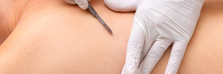 Dermaplaning Facial Treatments in Retford